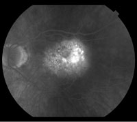 Both images (right and left) show the patient at baseline after at least 11 previous injections and before initiation of the study treatment (brachytherapy).