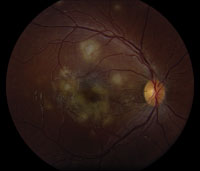 Multiple circumscribed, deep, white subretinal lesions in the macula, seen in the left eye greater than the right eye, without any evidence of vitritis or vasculitis.