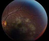 Multiple circumscribed, deep, white subretinal lesions in the macula, seen in the left eye greater than the right eye, without any evidence of vitritis or vasculitis.