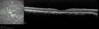 OCT shows intact external limiting membrane and inner/outer segment junction at the fovea.