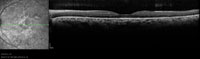 OCT shows intact external limiting membrane and inner/outer segment junction at the fovea.