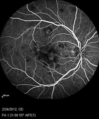 Fluorescein angiogram of both eyes shows early hypofluorescence consistent with nonperfusion and late hyperfluorescence consistent with leakage and staining.