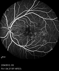 Fluorescein angiogram of both eyes shows early hypofluorescence consistent with nonperfusion and late hyperfluorescence consistent with leakage and staining.