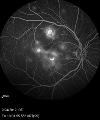 Fluorescein angiogram of both eyes shows early hypofluorescence consistent with nonperfusion and late hyperfluorescence consistent with leakage and staining.