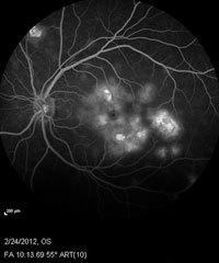 Fluorescein angiogram of both eyes shows early hypofluorescence consistent with nonperfusion and late hyperfluorescence consistent with leakage and staining.