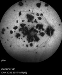 Indocyanine green angiography shows significant foci of hypofluorescence throughout. 