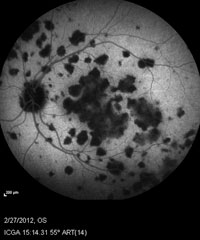 Indocyanine green angiography shows significant foci of hypofluorescence throughout. 