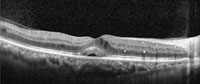 Spectral domain OCT of diabetic macular edema patient who previously had received three intravitreal bevacizumab injections with persistent cystoid macular edema at the fovea. 