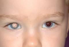 Typical white reflex in a child with retinoblastoma.