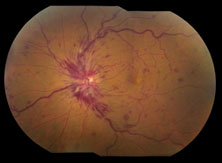 Figure 1. Long-standing, perfused, impending central retinal vein occlusion of the left eye.