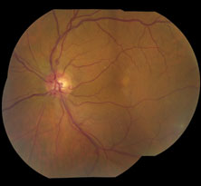 Figure 2. Same eye as in Figure 1, 2 months later. Fundus is near normal with a few collateral vessels on the retina and one retinal hemorrhage still present.