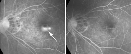 Marked shrinkage of non-subfoveal CNV due to pathologic myopia by anti-VEGF therapy. At onset (left image), the dye leakage from the CNV is seen in fluorescein angiogram. 