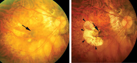 Development of chorioretinal atrophy around the regressed subfoveal CNV. At onset (left image), the grayish CNV is observed (arrow). 