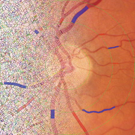 A blended image of color fundus and “splats” images from IVAN software.