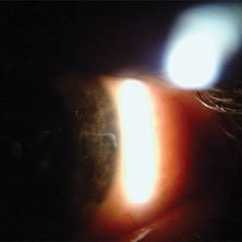 A linear scar at 3 o’clock appears to be full thickness through the cornea in the left eye.