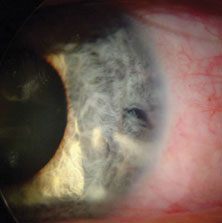  An iris defect underlying the corneal scar in the left eye.