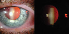 Retroillumination defect at the site of previously noted iris defect in the left eye. 