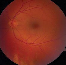 Dilated examination of the left eye revealed 1+ vitreous haze, retinal pigment epithelial changes inferiorly, sclerotic vessels inferiorly and an approximately 1-cm foreign body in the vitreous cavity resting on the retina inferiorly.