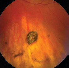 Dilated examination of the left eye revealed 1+ vitreous haze, retinal pigment epithelial changes inferiorly, sclerotic vessels inferiorly and an approximately 1-cm foreign body in the vitreous cavity resting on the retina inferiorly.