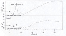 An ERG showed generalized decreased signal intensity in the left eye for photopic response.