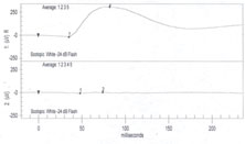 An ERG showed generalized decreased signal intensity in the left eye for scotopic response.