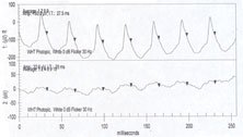 An ERG showed generalized decreased signal intensity in the left eye for 30 Hz flicker response.