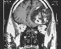 MRI scan