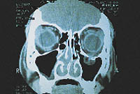 CT scan