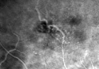 ICG angiography