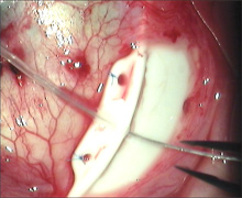 Acute Chemical burn [photo]