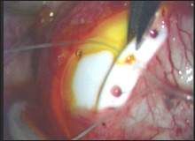 Acute Chemical burn [photo]