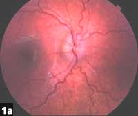 Figure 1a: Color fundus photograph showing marked disc edema