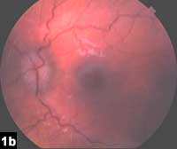 Figure 1b: Color fundus photograph showing dilated veins