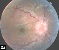 Figure 2a: Marked disc edema with hemorrhage and cotton-wool spots