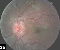 Figure 2b: Color fundus photograph revealing dilated, tortuous veins