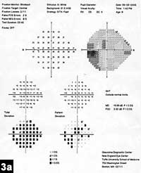 Figure 3a: Humphrey visual field test for patient 2