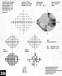 Figure 3b: Humphrey visual field test showing an enlarged blind spot