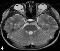 Figure 4: MRI with gadolinium (patient 2)