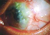 Patient with recurrent Mooren's ulcer after lamellar keratoplasty