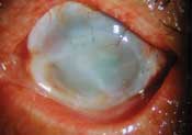 63-year-old patient with failed lamellar keratoplasty