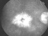 Classic cystoid macular degeneration