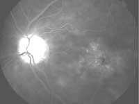 Classic cystoid macular degeneration