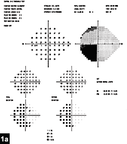 Figure 1a: Humphrey 24-2 visual field revealing homonymous left inferior quadrantanopia