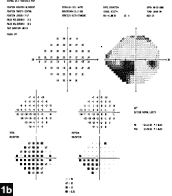 Figure 1b: Humphrey 24-2 visual field revealing homonymous left inferior quadrantanopia