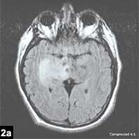 Figure 2a: Right hippocampal lesion