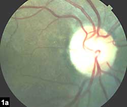 Figure 1a: Color photograph documenting mild temporal disc pallor in right eye