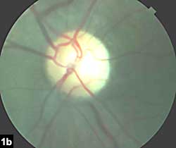 Figure 1b: Color photograph documenting mild temporal disc pallor in left eye