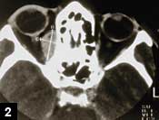 Figure 2: Enlargement of of right superior oblique muscle