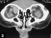 Figure 3: A coronal CT scan showing a large superior oblique muscle. 