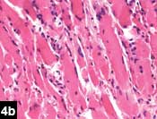 Figure 4b: Histopathologic slide showing muscle fibers and chornic inflammatory cells